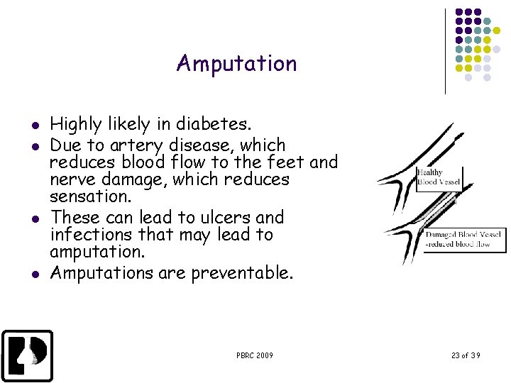 Amputation l l Highly likely in diabetes. Due to artery disease, which reduces blood