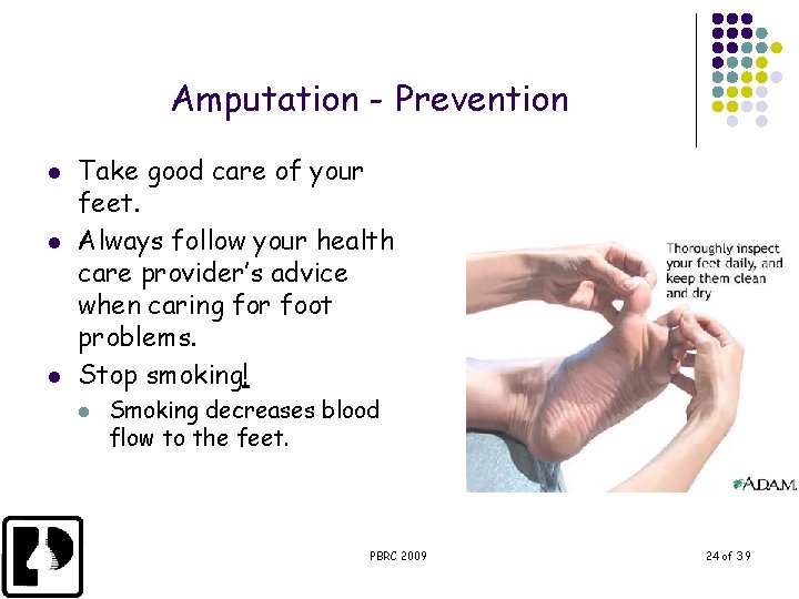 Amputation - Prevention l l l Take good care of your feet. Always follow