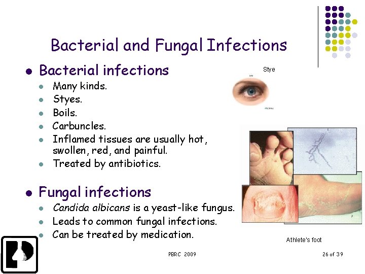 Bacterial and Fungal Infections l Bacterial infections l l l l Stye Many kinds.