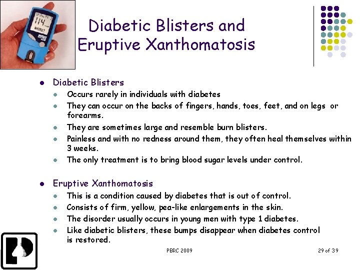 Diabetic Blisters and Eruptive Xanthomatosis l Diabetic Blisters l l l Occurs rarely in