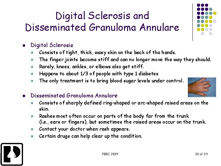Digital Sclerosis and Disseminated Granuloma Annulare l Digital Sclerosis l l l Consists of