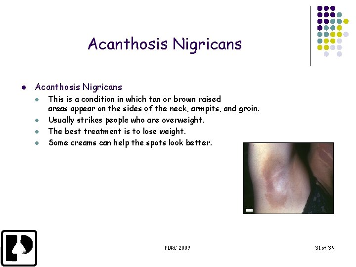 Acanthosis Nigricans l l l l This is a condition in which tan or