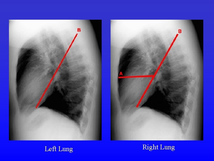 Left Lung Right Lung 