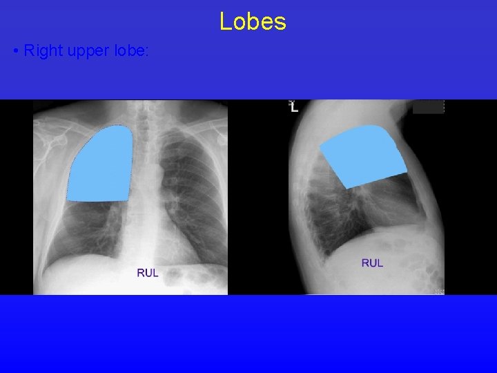 Lobes • Right upper lobe: 