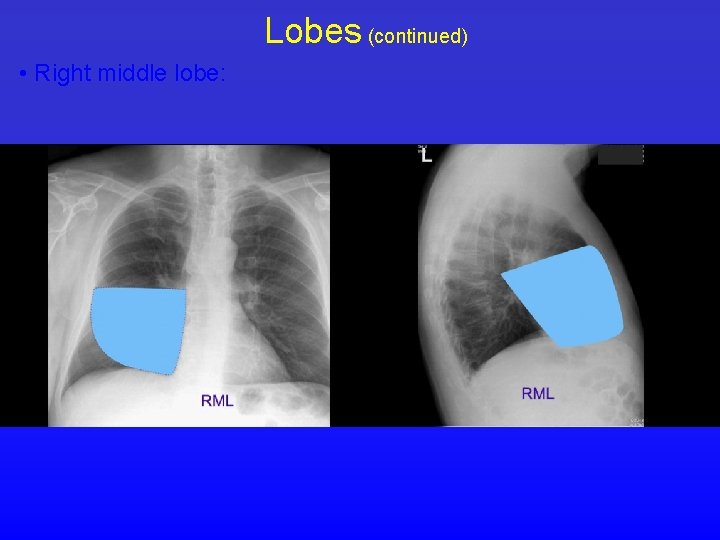 Lobes (continued) • Right middle lobe: 