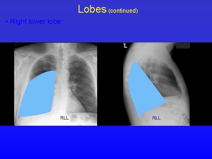 Lobes (continued) • Right lower lobe: 
