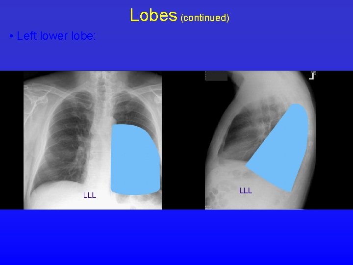 Lobes (continued) • Left lower lobe: 