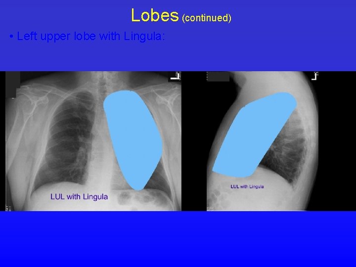 Lobes (continued) • Left upper lobe with Lingula: 