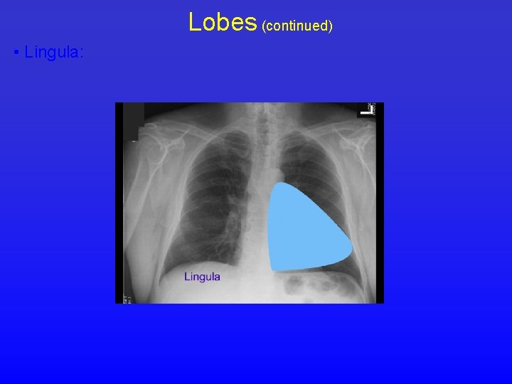 Lobes (continued) • Lingula: 
