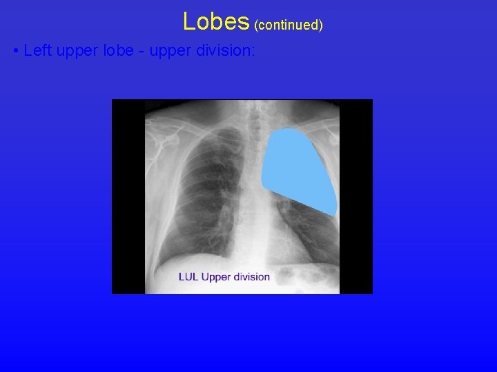 Lobes (continued) • Left upper lobe - upper division: 
