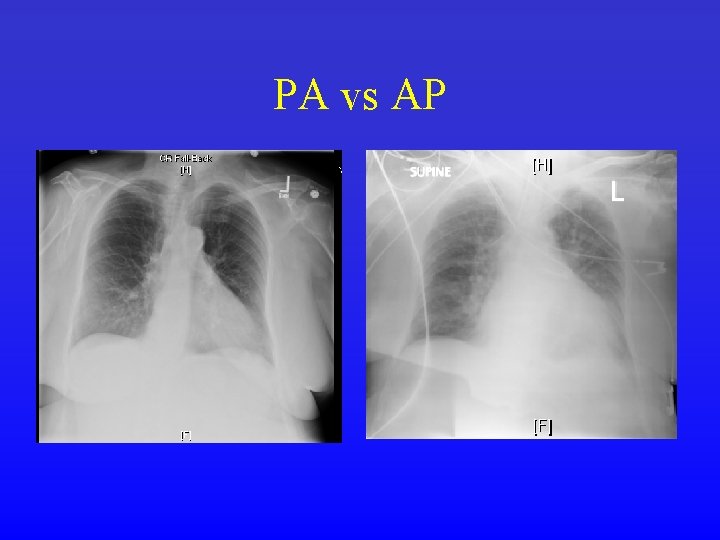 PA vs AP 