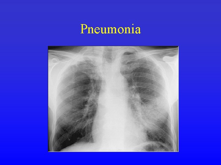 Pneumonia 