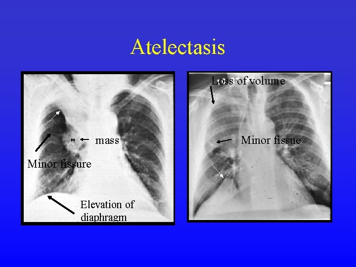 Atelectasis Loss of volume mass Minor fissure Elevation of diaphragm Minor fissue 