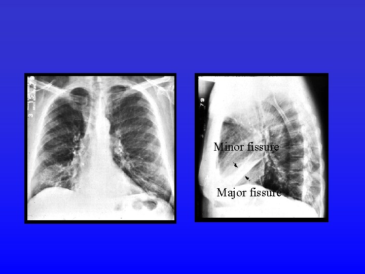 Minor fissure Major fissure 