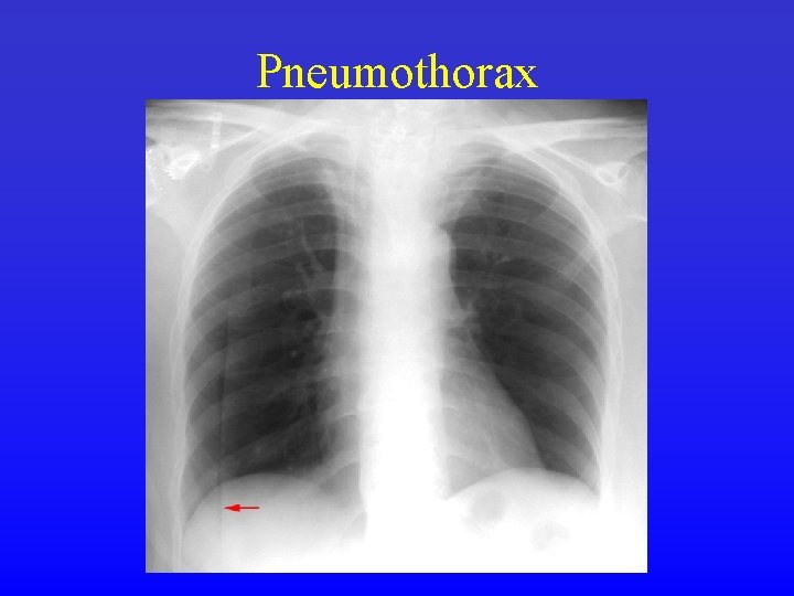 Pneumothorax 