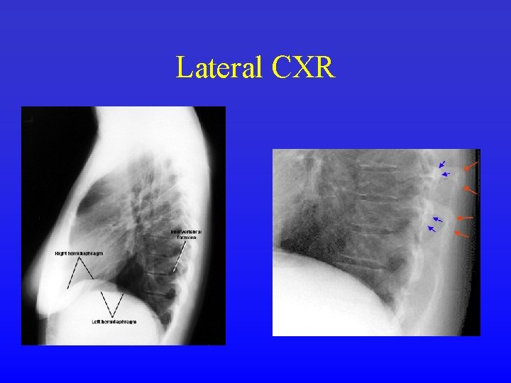 Lateral CXR 