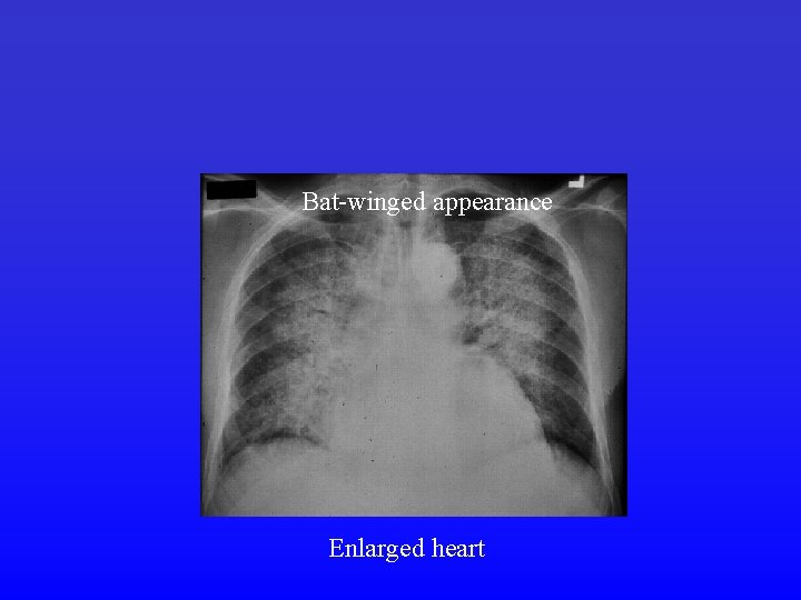 Bat-winged appearance Enlarged heart 