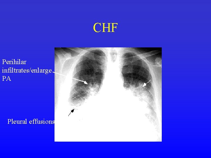 CHF Perihilar infiltrates/enlarge PA Pleural effusions 