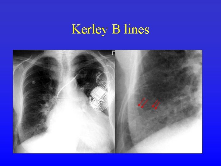 Kerley B lines 