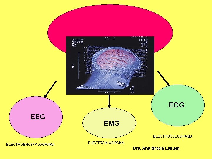 POLISOMNOGRAFÍA EOG EEG EMG ELECTROCULOGRAMA ELECTROENCEFALOGRAMA ELECTROMIOGRAMA Dra. Ana Gracia Lasuen 