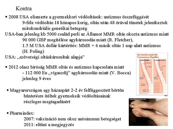 Kontra § 2008 USA elismerte a gyermekkori védőoltások: autizmus összefüggését 9 -féle védőoltás 18