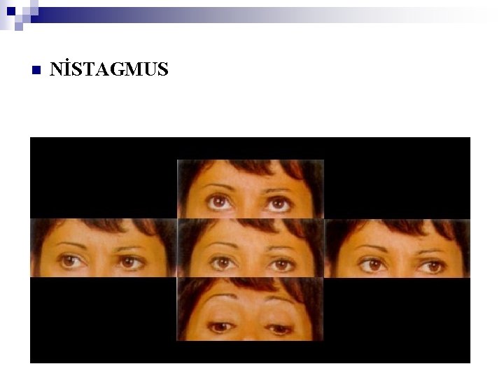 n NİSTAGMUS 