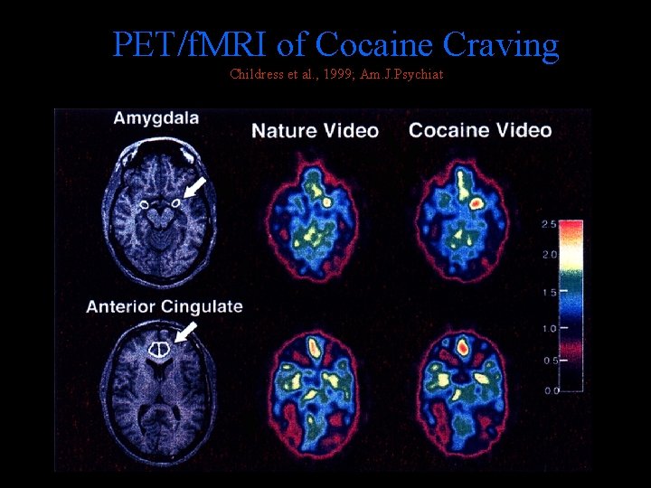 PET/f. MRI of Cocaine Craving Childress et al. , 1999; Am. J. Psychiat 