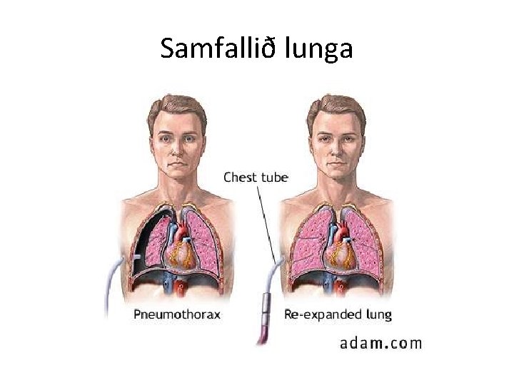 Samfallið lunga 