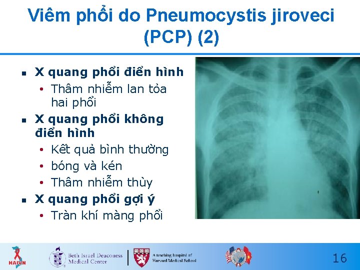 Viêm phổi do Pneumocystis jiroveci (PCP) (2) n n n X quang phổi điển