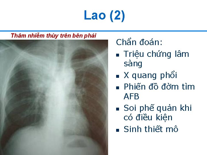 Lao (2) Thâm nhiễm thùy trên bên phải Chẩn đoán: n Triệu chứng lâm