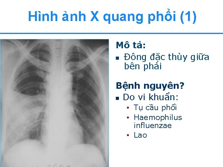 Hình ảnh X quang phổi (1) Mô tả: n Đông đặc thùy giữa bên