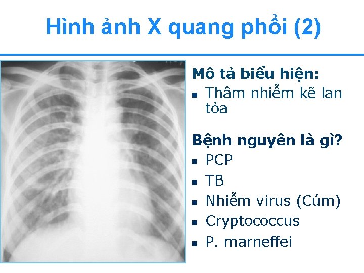 Hình ảnh X quang phổi (2) Mô tả biểu hiện: n Thâm nhiễm kẽ