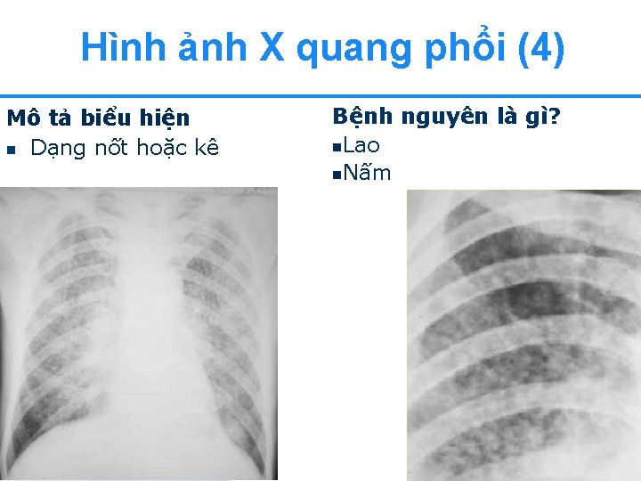 Hình ảnh X quang phổi (4) Mô tả biểu hiện n Dạng nốt hoặc