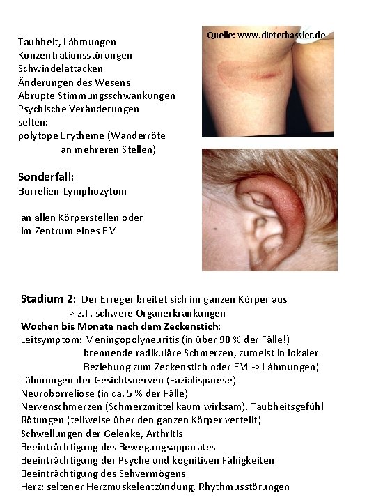 Taubheit, Lähmungen Konzentrationsstörungen Schwindelattacken Änderungen des Wesens Abrupte Stimmungsschwankungen Psychische Veränderungen selten: polytope Taubheit, Lähmungen Konzentrationsstörungen Schwindelattacken Änderungen des Wesens Abrupte Stimmungsschwankungen Psychische Veränderungen selten: polytope