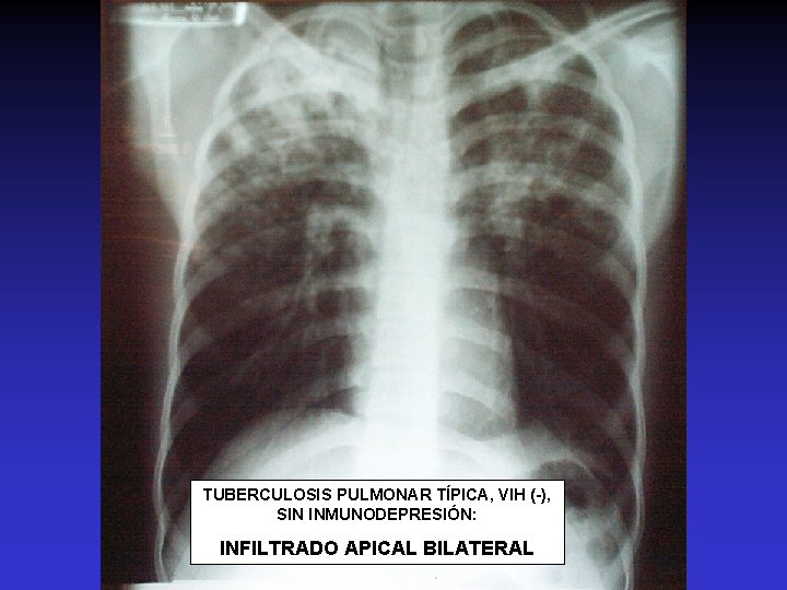 TUBERCULOSIS PULMONAR TÍPICA, VIH (-), SIN INMUNODEPRESIÓN: INFILTRADO APICAL BILATERAL 