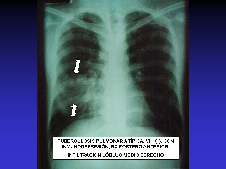 TUBERCULOSIS PULMONAR ATÍPICA, VIH (+), CON INMUNODEPRESIÓN, RX PÓSTERO-ANTERIOR: INFILTRACIÓN LÓBULO MEDIO DERECHO 