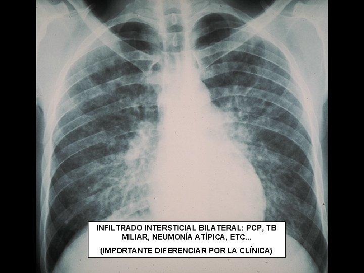 INFILTRADO INTERSTICIAL BILATERAL: PCP, TB MILIAR, NEUMONÍA ATÍPICA, ETC. . . (IMPORTANTE DIFERENCIAR POR