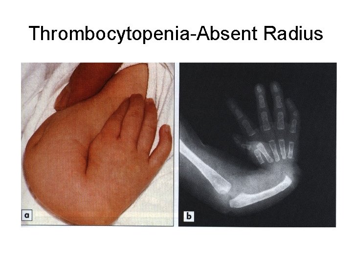 Thrombocytopenia-Absent Radius 