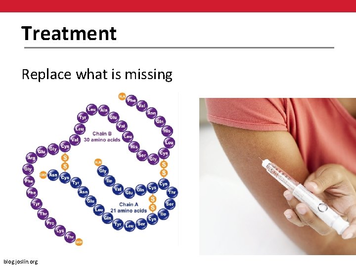 Treatment Replace what is missing blog. joslin. org 