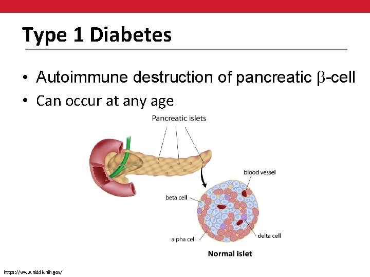Type 1 Diabetes • Autoimmune destruction of pancreatic -cell • Can occur at any