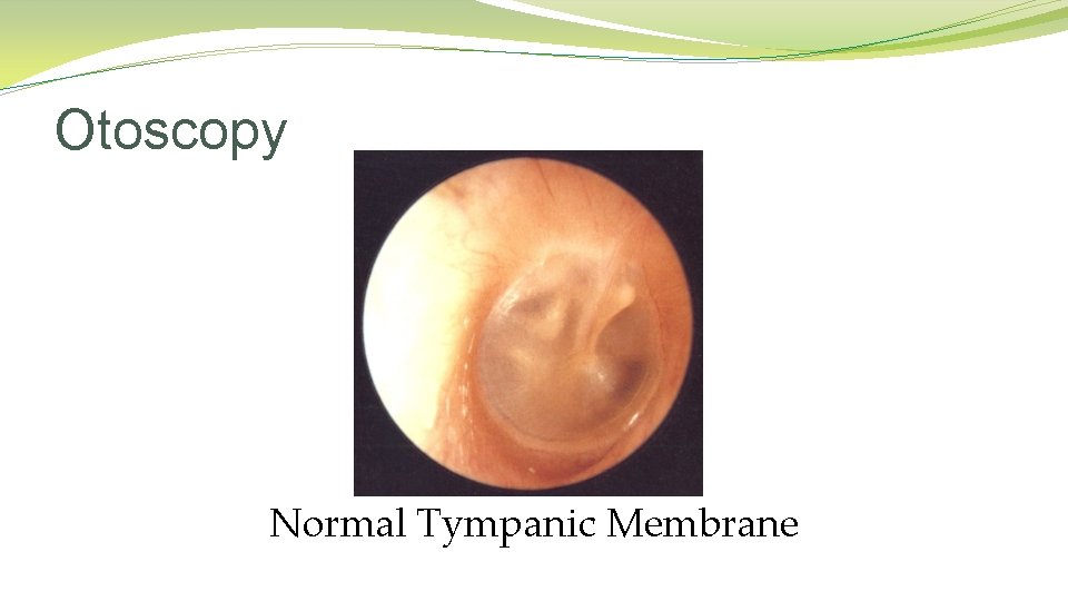 Otoscopy Normal Tympanic Membrane Otoscopy Normal Tympanic Membrane