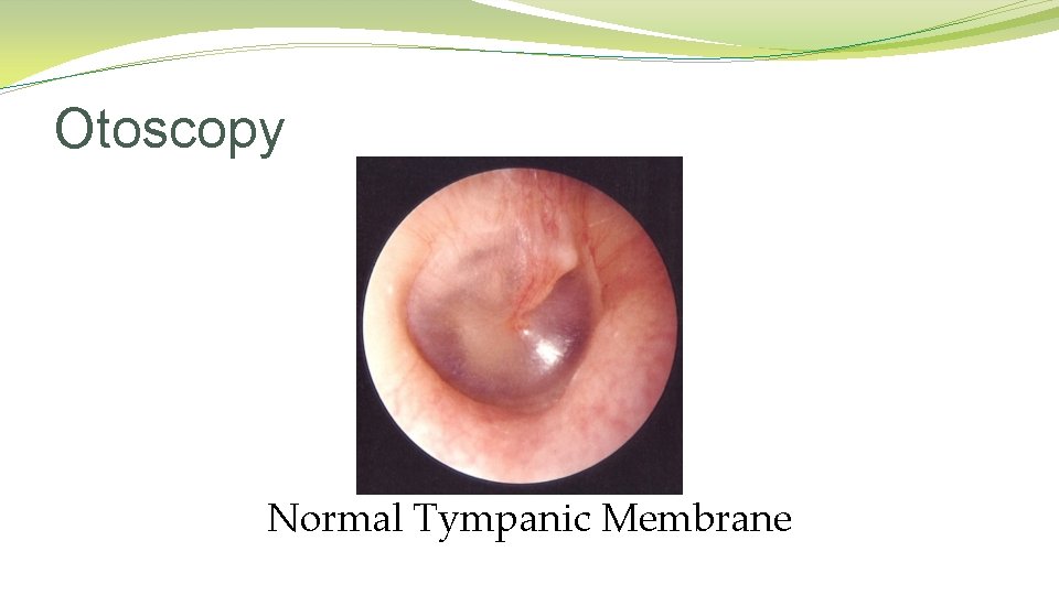 Otoscopy Normal Tympanic Membrane Otoscopy Normal Tympanic Membrane