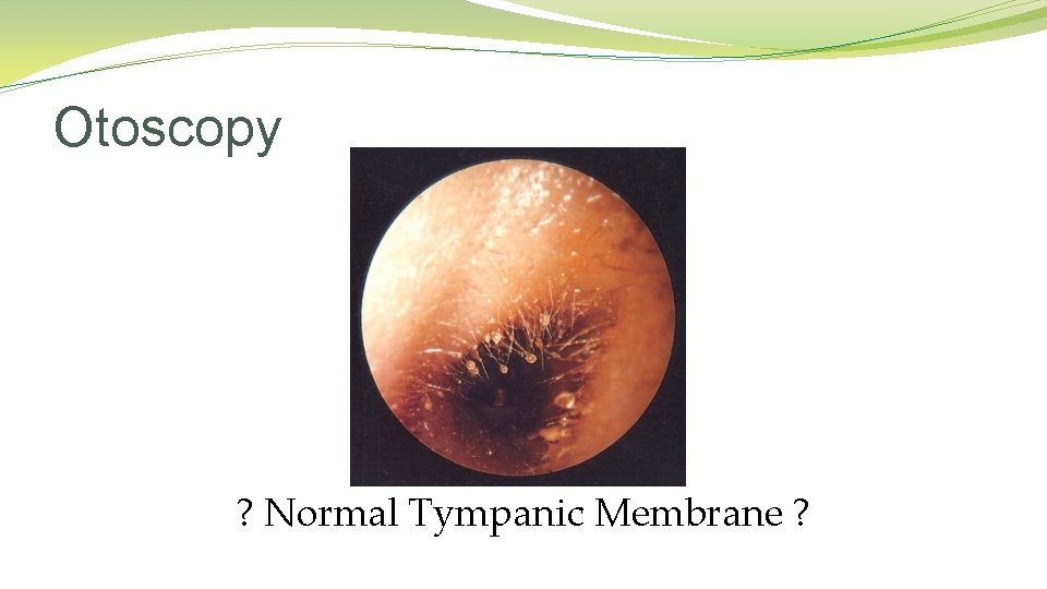 Otoscopy ? Normal Tympanic Membrane ? Otoscopy ? Normal Tympanic Membrane ?