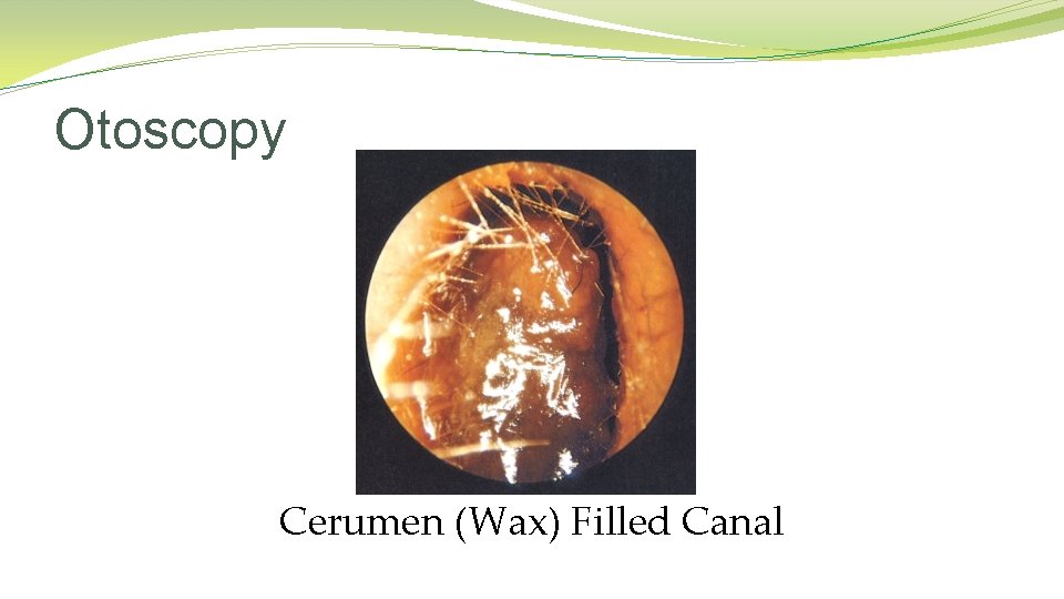 Otoscopy Cerumen (Wax) Filled Canal Otoscopy Cerumen (Wax) Filled Canal