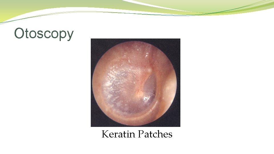 Otoscopy Keratin Patches Otoscopy Keratin Patches