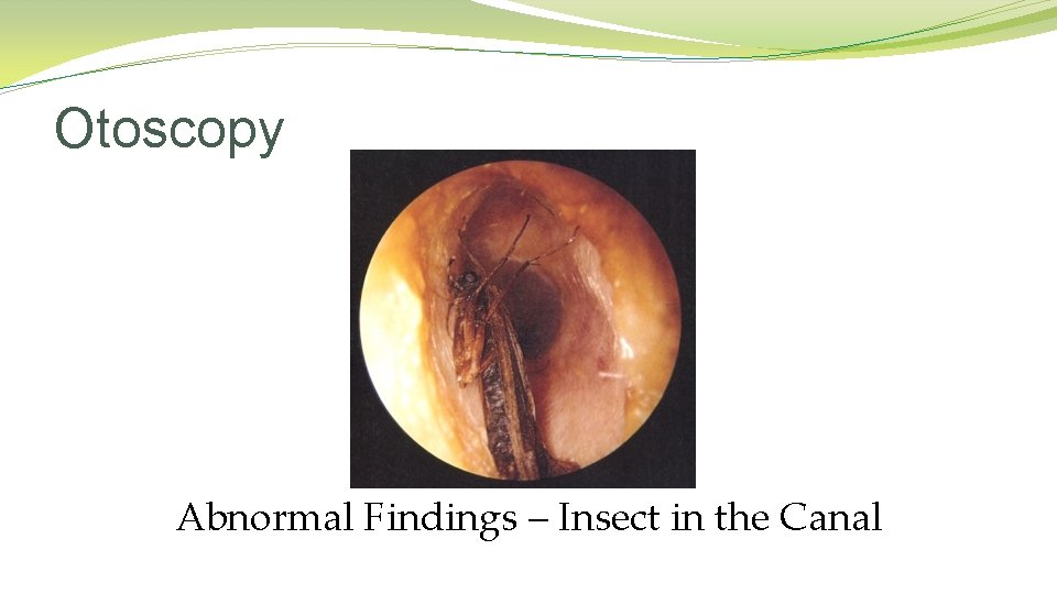 Otoscopy Abnormal Findings – Insect in the Canal Otoscopy Abnormal Findings – Insect in the Canal