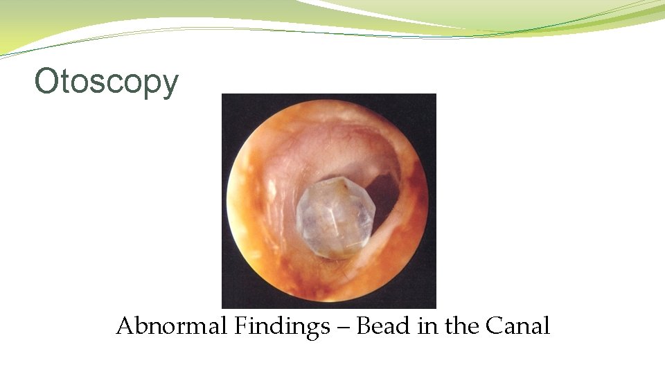 Otoscopy Abnormal Findings – Bead in the Canal Otoscopy Abnormal Findings – Bead in the Canal