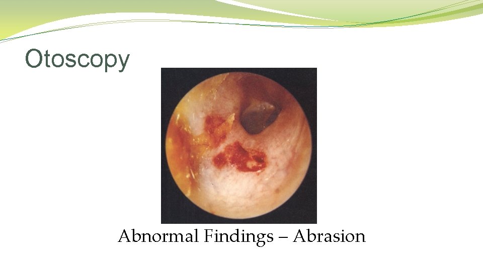 Otoscopy Abnormal Findings – Abrasion Otoscopy Abnormal Findings – Abrasion