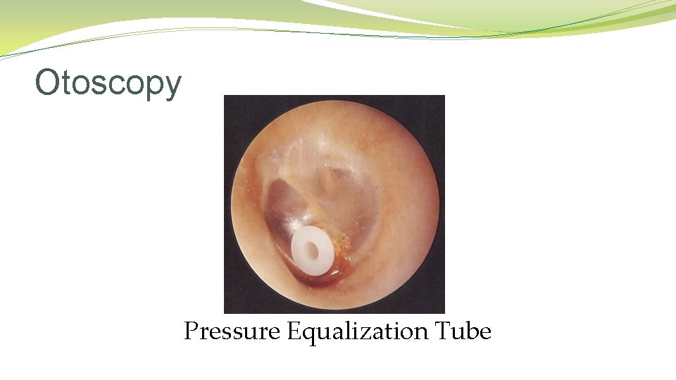 Otoscopy Pressure Equalization Tube Otoscopy Pressure Equalization Tube