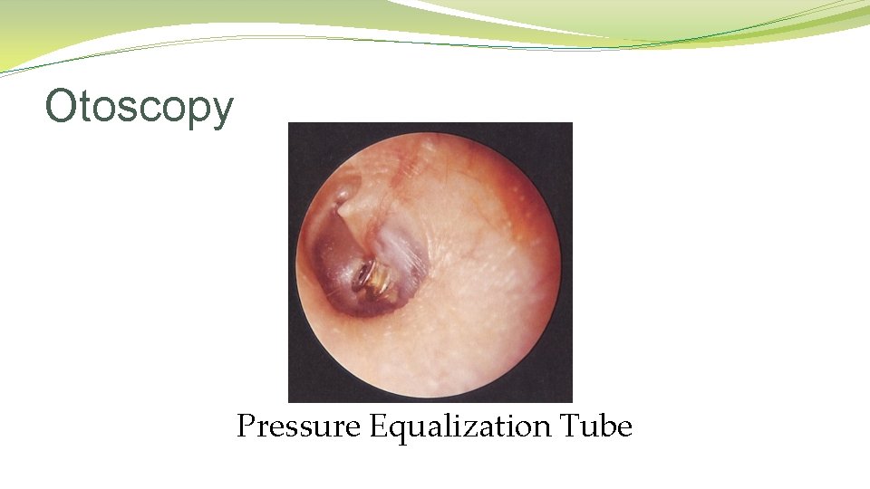 Otoscopy Pressure Equalization Tube Otoscopy Pressure Equalization Tube
